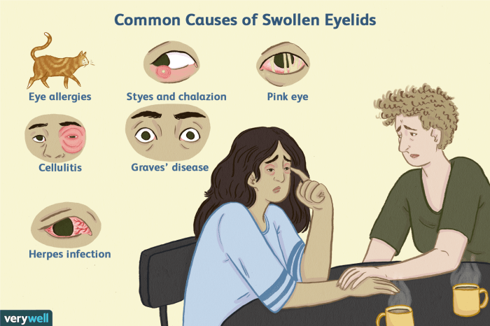 Swollen eyelid injury